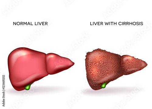 Normal healthy liver and Liver with Cirrhosis photo