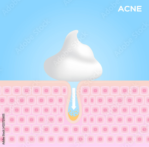 foam cream moose and lotion apply on acne skin and take out the acne . vector graphic