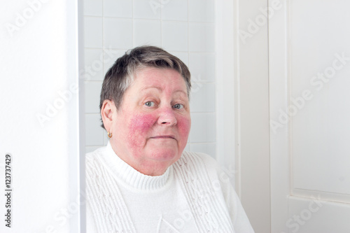 Rosacea, facial skin disorder, portrait of unhappy elderly woman