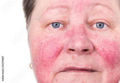 Elderly woman with rosacea, facial skin disorder, no make-up