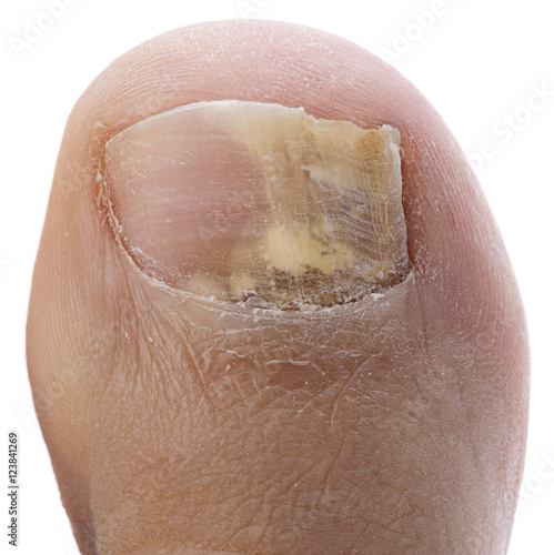 Fungus Infection on Nails of a Man's Toe 