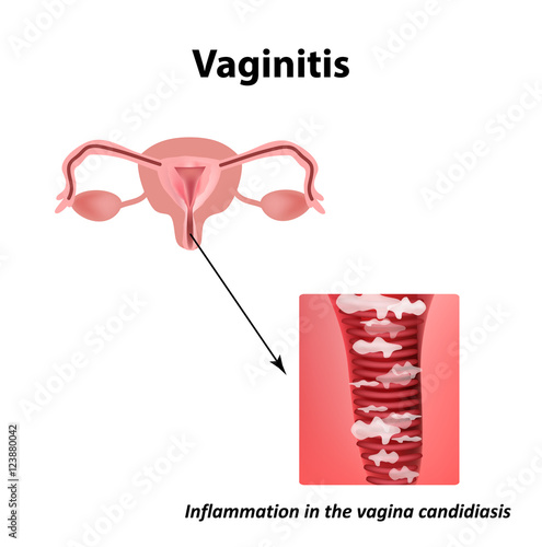 Vaginitis. Inflammation in the vagina candidiasis thrush. The structure of the pelvic organs. Infographics. Vector illustration on isolated background