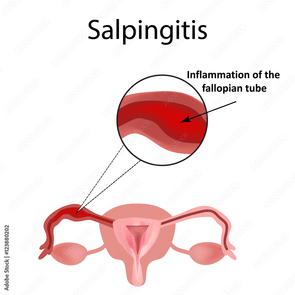 Salpingitis. Inflammation Of The Fallopian Tube. Oophoritis. Inflammation  Of The Ovary. Pelvic Organs. Infographics. Vector Illustration On Isolated  Background. Royalty Free SVG, Cliparts, Vectors, and Stock Illustration.  Image 68281130.