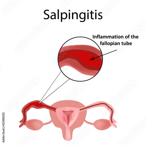 Salpingitis. Inflammation of the fallopian tube. Infographics. Vector illustration on isolated background