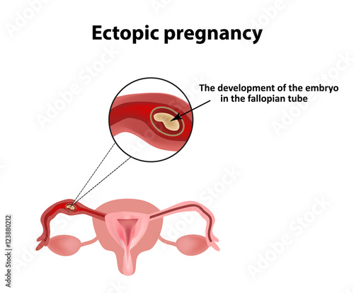 Ectopic pregnancy. The embryo in the fallopian tube. Infographics. Vector illustration on isolated background