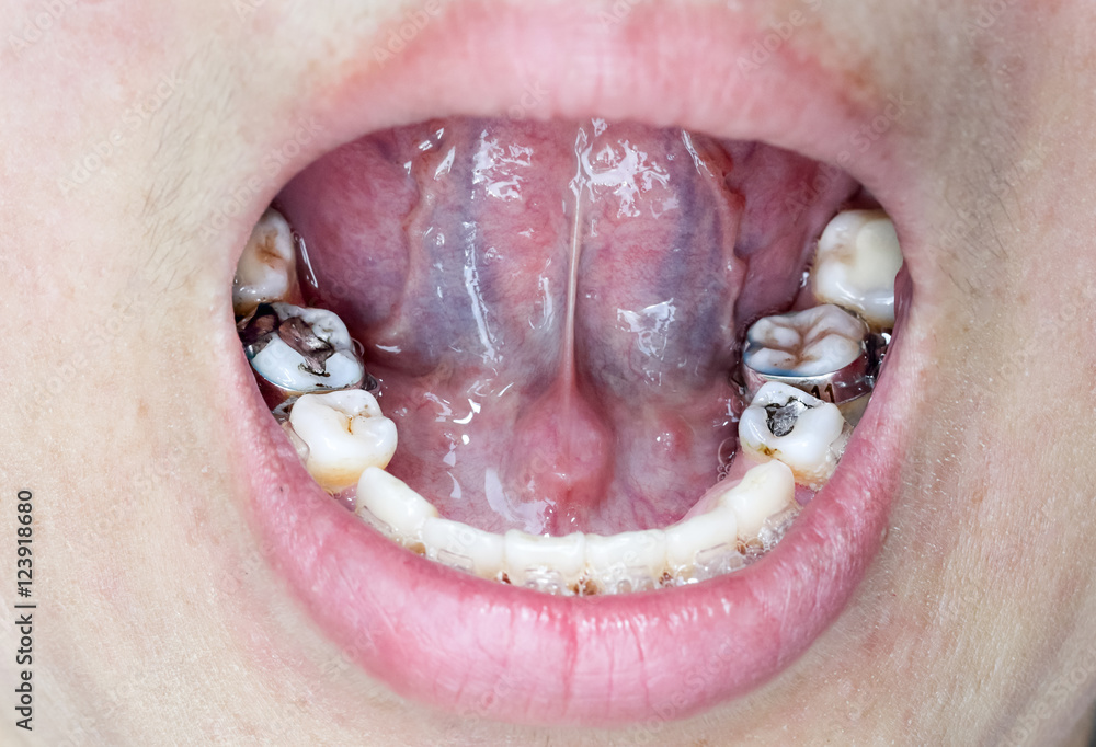 Obraz premium Close-up mouth of crooked teeth with braces