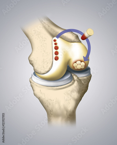 A method of cartilage transplantation in the knee