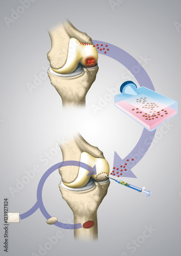 A method of cartilage transplantation in the knee photo