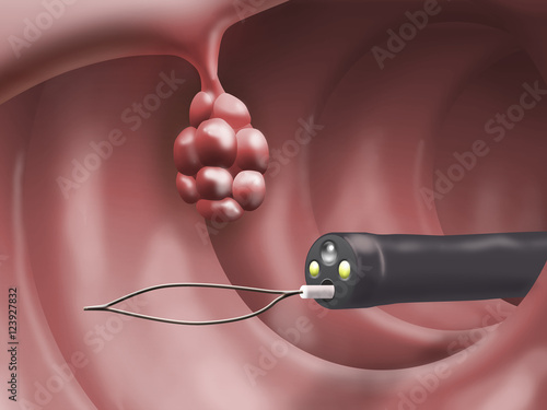 Surgical removal of an intestinal polyp by endoscope
