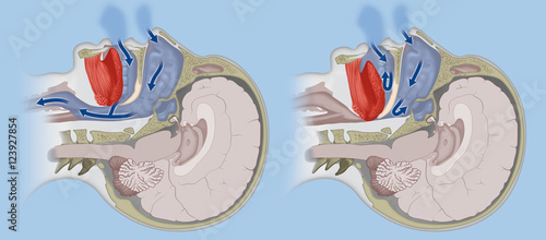 A cross section of a human head, comparing normal breathing with sleep apnoea 