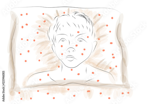 measles