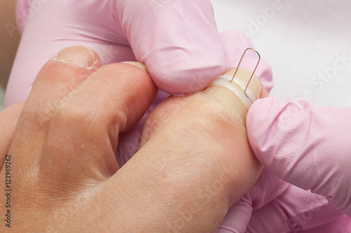 Doctor Podiatry removes calluses, corns and treats ingrown nail. Hardware manicure. Concept body care.
