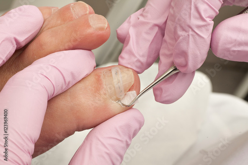Doctor Podiatry removes calluses, corns and treats ingrown nail. Hardware manicure. Concept body care.
