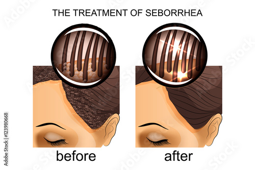 the treatment of seborrhea of the scalp. before and after photo