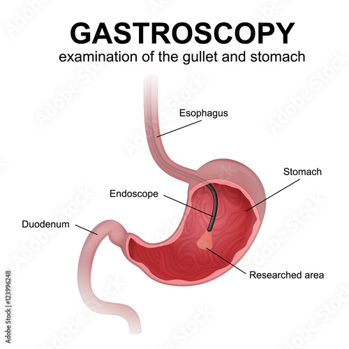 gastroscopy procedure EGD