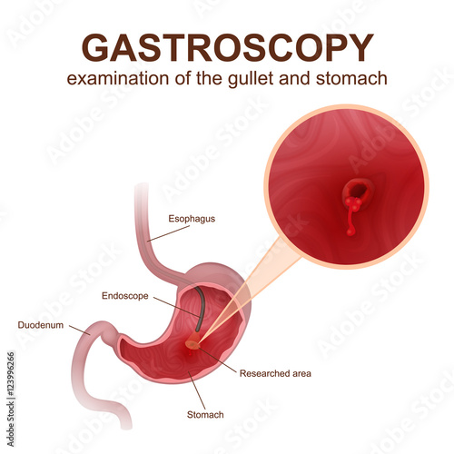 gastroscopy procedure EGD