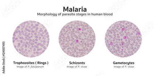 Microscopic examination of blood films from malaria infected pat photo