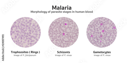 Foto Microscopic examination of blood films from malaria infected pat