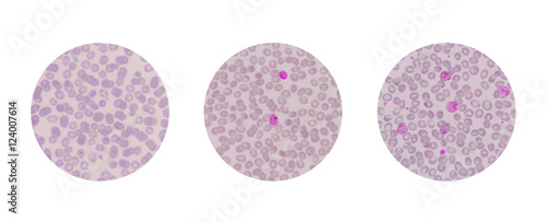 Bild auf Leinwand Microscopic examination of blood films from malaria infected pat