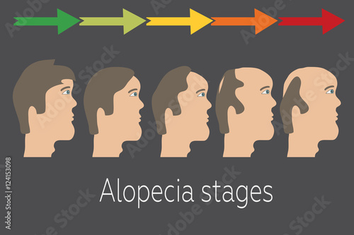 Alopecia stages set. Front view of a man losing hair. Male baldness. Male hair loss pattern.  Hair care concept. Vector illustration.