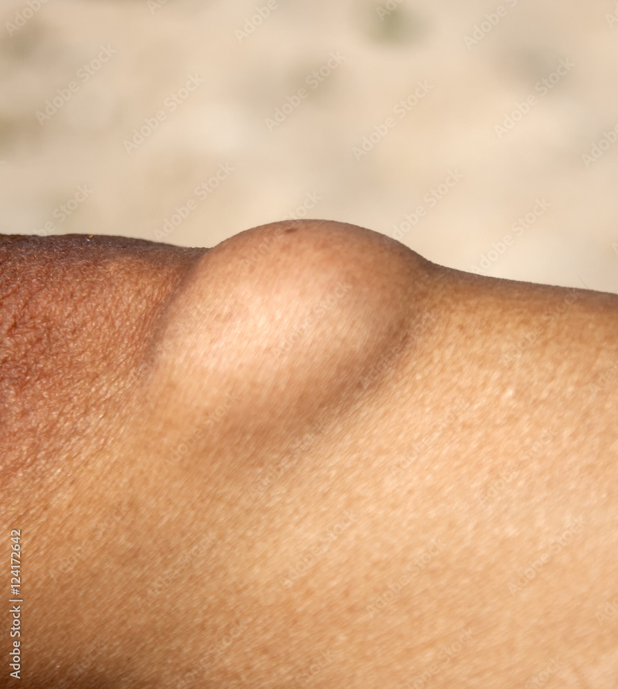 Fototapeta premium Lipoma