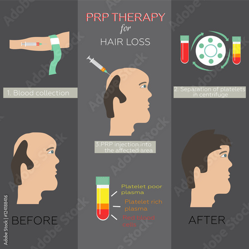 Platelet rich plasma injection. PRP therapy process. Male hair loss treatment infographics. Mesotherapy. Hair growth stimulation.