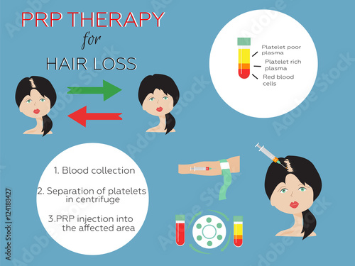 Platelet rich plasma injection. PRP therapy process. Female hair loss treatment infographics. Meso therapy. Hair growth stimulation.