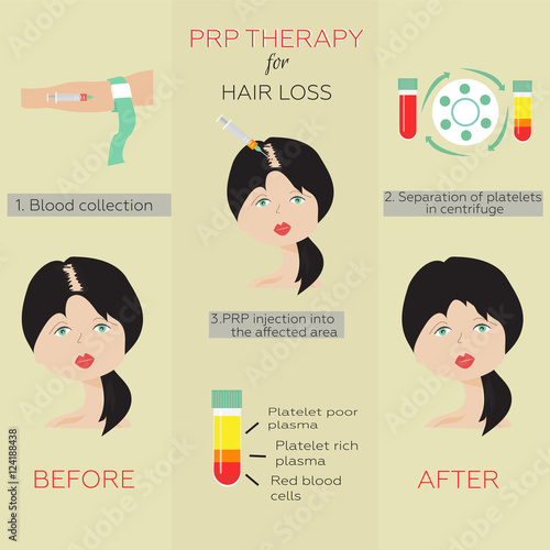 Platelet rich plasma injection. PRP therapy process. Female hair loss treatment infographics. Meso therapy. Hair growth stimulation.