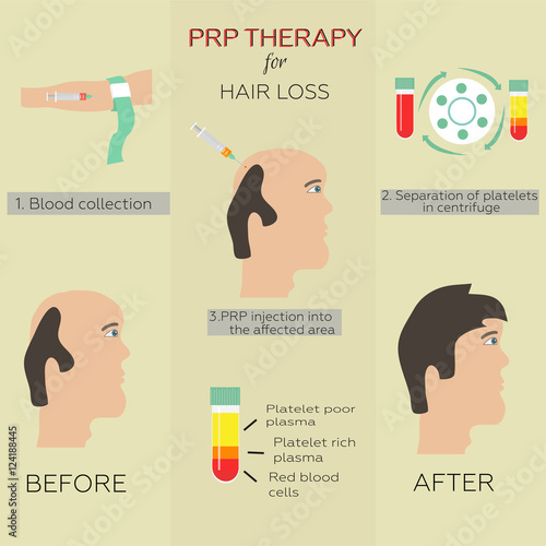 Platelet rich plasma injection. PRP therapy process. Male hair loss treatment infographics. Mesotherapy. Hair growth stimulation.