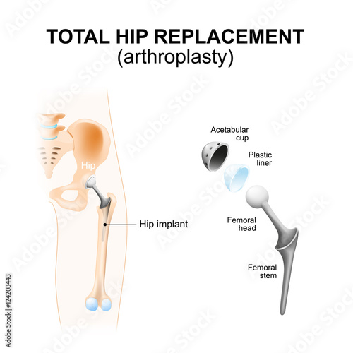 Total hip replacement or arthroplasty.