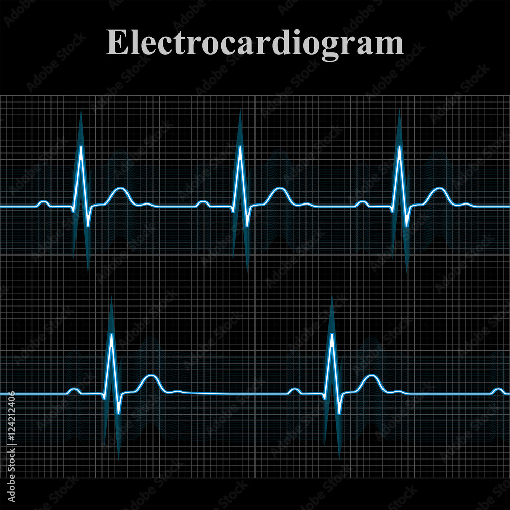 Normal and bradycardial ekg charts