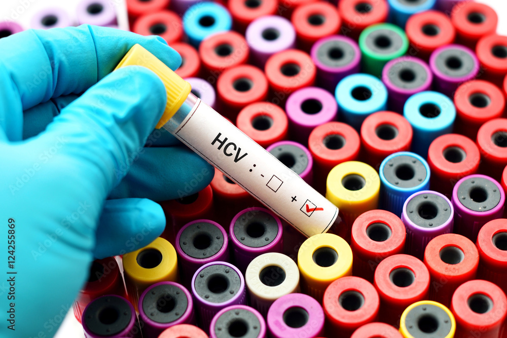 Fototapeta premium Blood sample with hepatitis C virus (HCV) positive