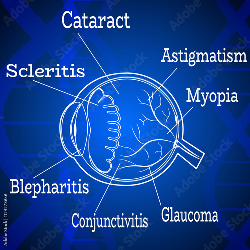 Human eye diseases anatomy structure.Medical infographics for ophthalmology clinic,vector illustration.List of ailments - cataract, astigmatism,myopia,glaucoma eye anatomy on dna chain blue wallpaper. photo