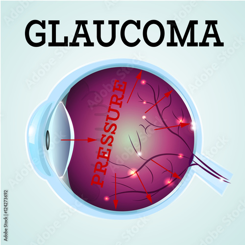 Human Glaucoma disease anatomy structure.Medical infographics for ophthalmology clinic,vector illustration.Cause of disease,eye anatomy - high level pressure,Medical infographics for optician clinic.