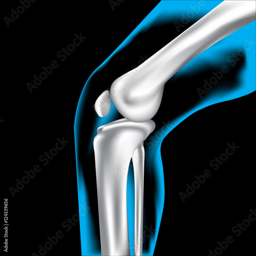 Knee pain ,X-Ray ,Knee Scan