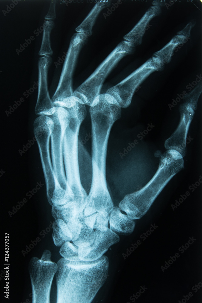 Röntgenbild einer Hand Links Röntgenbild einer Hand Links
