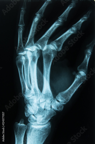 Röntgenbild einer Hand Links