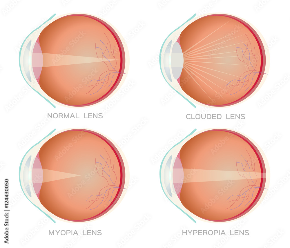 Normal , Myopia , hyperopia and clouded eye lens vector. Eye vision disorder. anatomy
