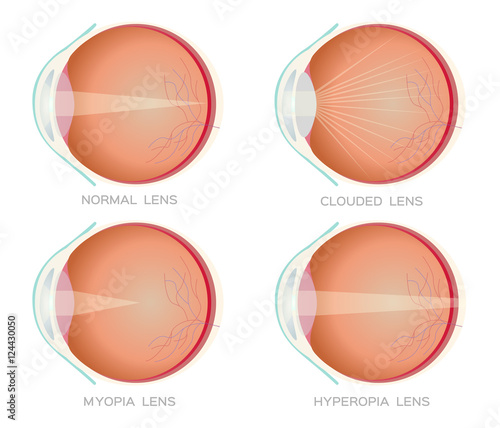 Normal , Myopia , hyperopia and clouded eye lens vector. Eye vision disorder. anatomy   © gritsalak