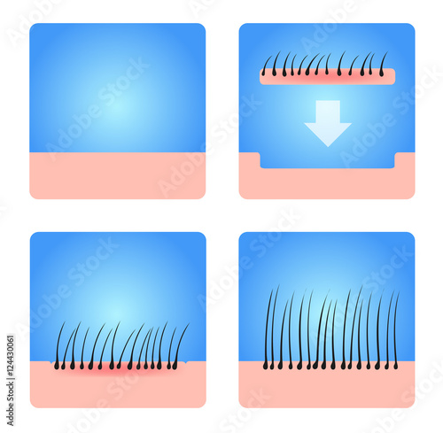 hair transplantation vector . black hair photo