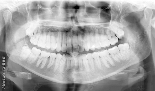 Dental X-Ray of teeth