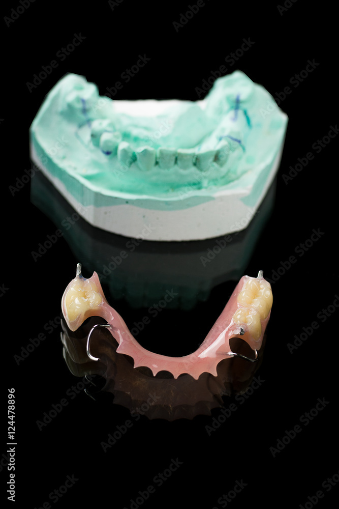 Acrylic partial denture provisional prosthesis Stock Photo Adobe Stock