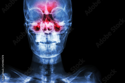 Sinusitis. film x-ray skull AP ( anterior - posterior ) show infection and inflammation at frontal sinus , ethmoid sinus , maxillary sinus and blank area at right side