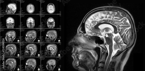 Magnetic resonance imaging of the brain