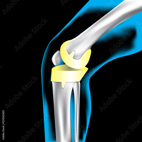 Artificial bone knee, X-Ray, Knee Scan