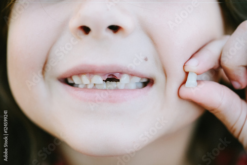 Young girl with one missing milk tooth.
