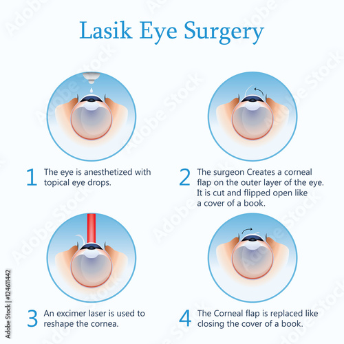 Lasik eye surgery. Vector Illustration photo
