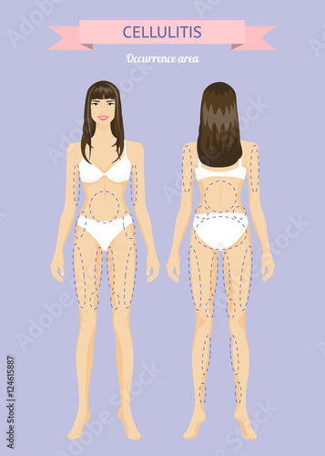 Beautiful young woman. Areas of development of cellulite. Infographics