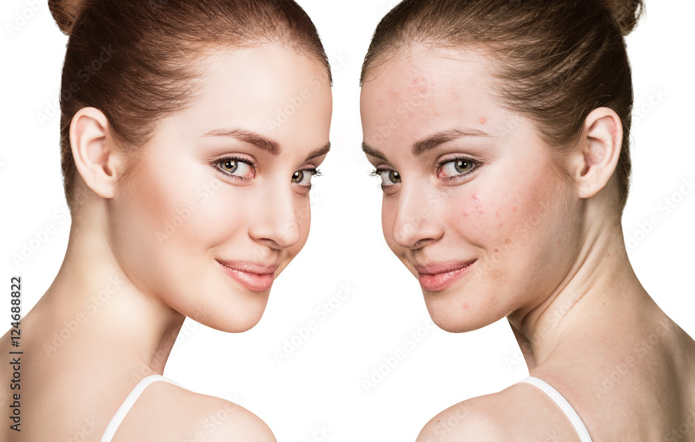 Girl with acne before and after treatment - obrazy, fototapety, plakaty 
