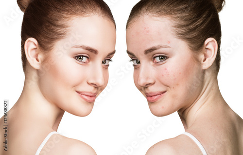 Girl with acne before and after treatment photo